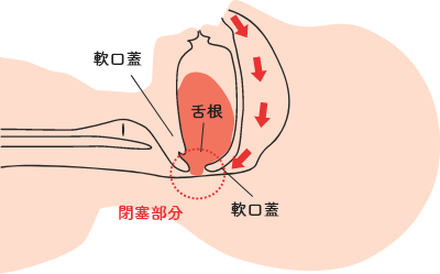 図2：患者の気道閉塞 SAS患者の気道閉塞