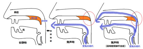 鼻咽腔閉鎖不全