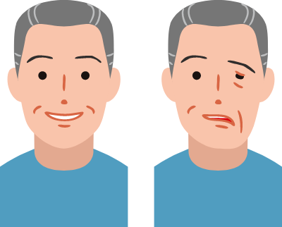 顔面神経麻痺イメージ