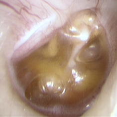 右耳の滲出性中耳炎