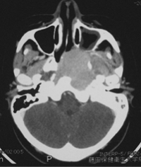 数ヶ月治らない滲出性中耳炎