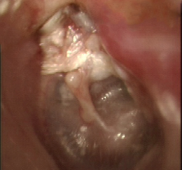 真珠腫性中耳炎。鼓膜の上の部分がえぐれて真珠腫が溜まっている