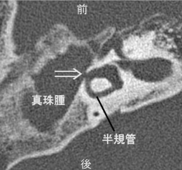 真珠腫性中耳炎。進行して三半規管に穴があき、めまいが出現した