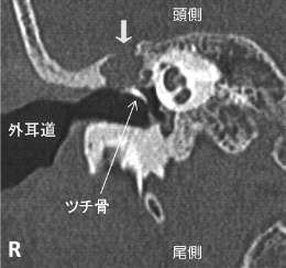 真珠腫性中耳炎。真珠腫により頭蓋底の骨が溶けてしまっている