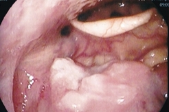 舌根にできたがん