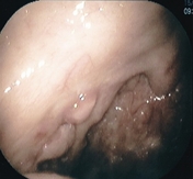 右扁桃にできたがん