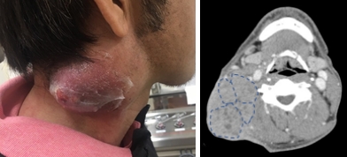Matted nodesの症例