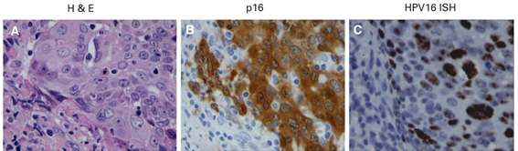 中咽頭がん組織からHPV-DNAをPCR法とISH法およびp16免疫染色で検出して比較