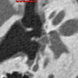 耳かき外傷による、アブミ骨骨折と、前庭窓陥入の描出例。微細な病的変化を描出できることから、病態を画像的にも支持できるようになった