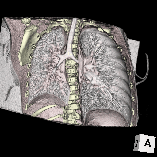 左気管支異物（上記⑦）。主気管支に異物が嵌頓しているため左肺が過膨張し、右肺でのみ換気が行われている様子が視覚的に把握できる