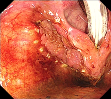 図3：下咽頭癌に対する内視鏡手術 摘出前
