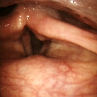 喉頭形成   左反回回神経麻痺　声は小さく、長く話せない