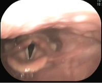 35才女性内転型痙攣性発声障害 ボツリヌス製剤注射前