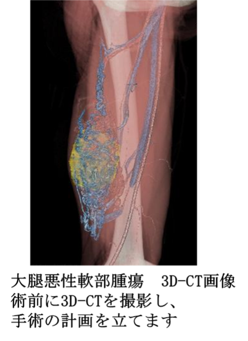 大腿悪性軟部腫瘍　3D-CT画像術前に3D-CTを撮影し、手術の計画を立てます