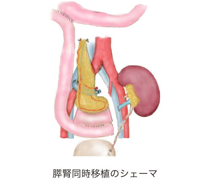 膵腎同時移植のシェーマ