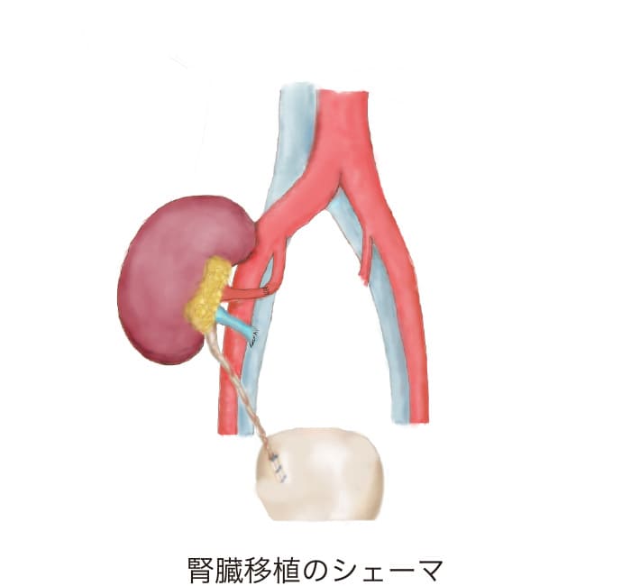 腎移植のシェーマ