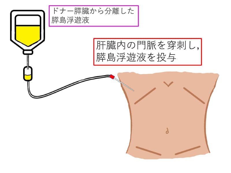 肝臓内の門脈を穿刺し、膵島浮遊液を投与