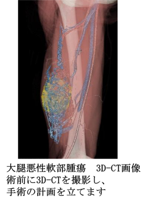 大腿悪性軟部腫瘍 3D-CT画像術前に3D-CTを撮影し、手術の計画を立てます