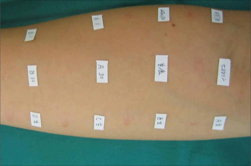 プリックテスト