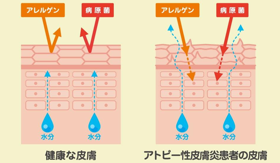 アトピー性皮膚炎患者の皮膚