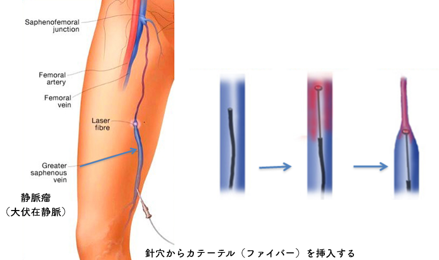 下肢静脈瘤どうやって治すの？ | 藤田医科大学 ばんたね病院 消化器外科