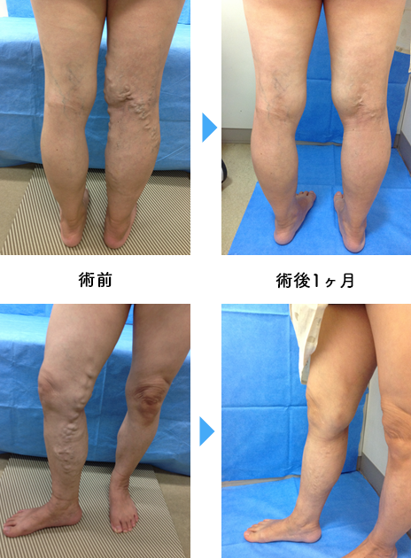 下肢静脈瘤どうやって治すの 藤田医科大学 ばんたね病院 消化器外科