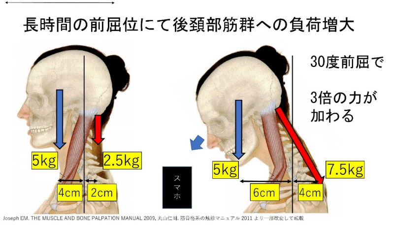 長時間の前屈位にて後頚部筋群への負担増大