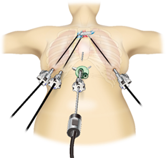 縦隔腫瘍の手術 | 手術について | 藤田医科大学岡崎医療センター