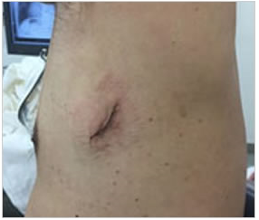 当院の傷一つで行う肺癌内視鏡手術