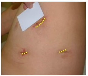 一般的な胸腔鏡手術