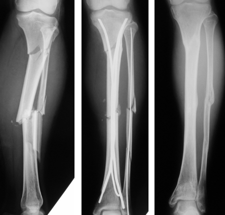 図6　脛骨分節骨折に対するEnder髄内釘固定術