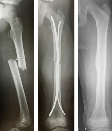 図7　学童期の大腿骨骨幹部骨折に対するEnder髄内釘固定術