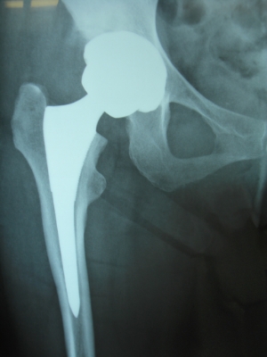 ５０歳　変形性股関節症　ＭＩＳ-DＡによる人工股関節置換術
