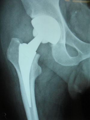 ５８歳　大腿骨頭壊死　ＭＩＳ-DAによる右人工股関節置換術