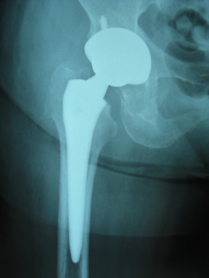 ８６歳　続発性変形性股関節症　ＭＩＳ-DAによる右人工股関節置換術