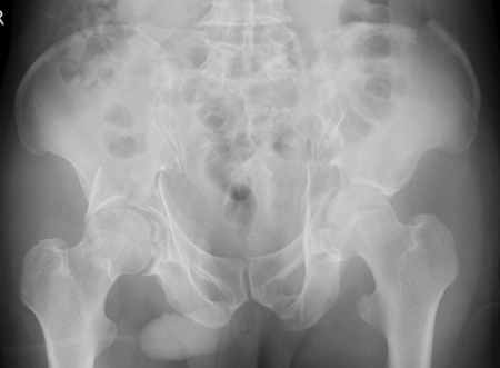 両側寛骨臼骨折 受傷時レントゲン