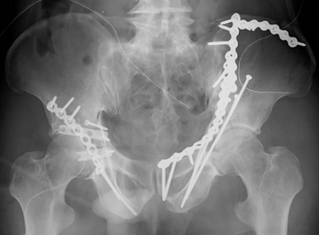 両側寛骨臼骨折 術後レントゲン