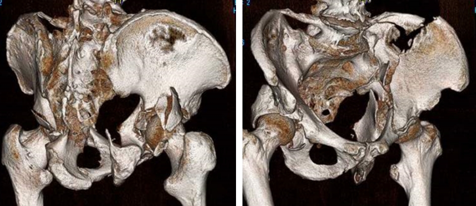 側寛骨臼骨折3D-CT