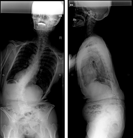 手術前脊椎全長X線写真正面像/側面像