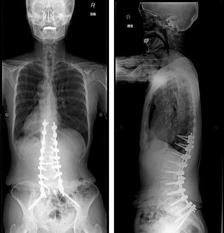 手術後脊椎全長X線写真正面像/側面像