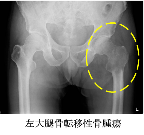 左大腿骨転移性骨腫瘍