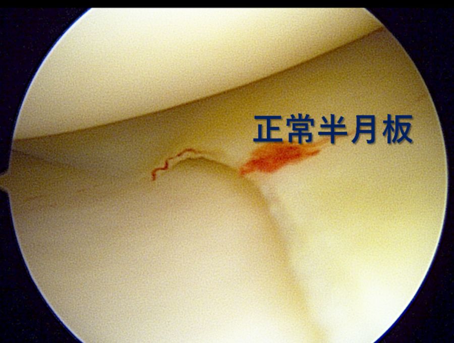 正常な半月板です。