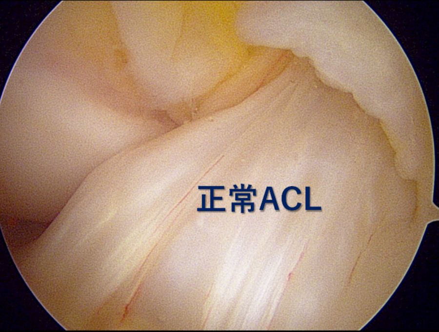 正常な前十字靭帯（ACL）です。