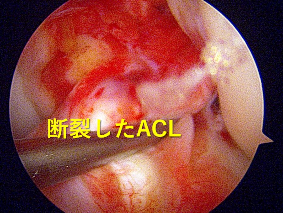 断裂した前十字靭帯です。断裂により靭帯の連続性がありません。