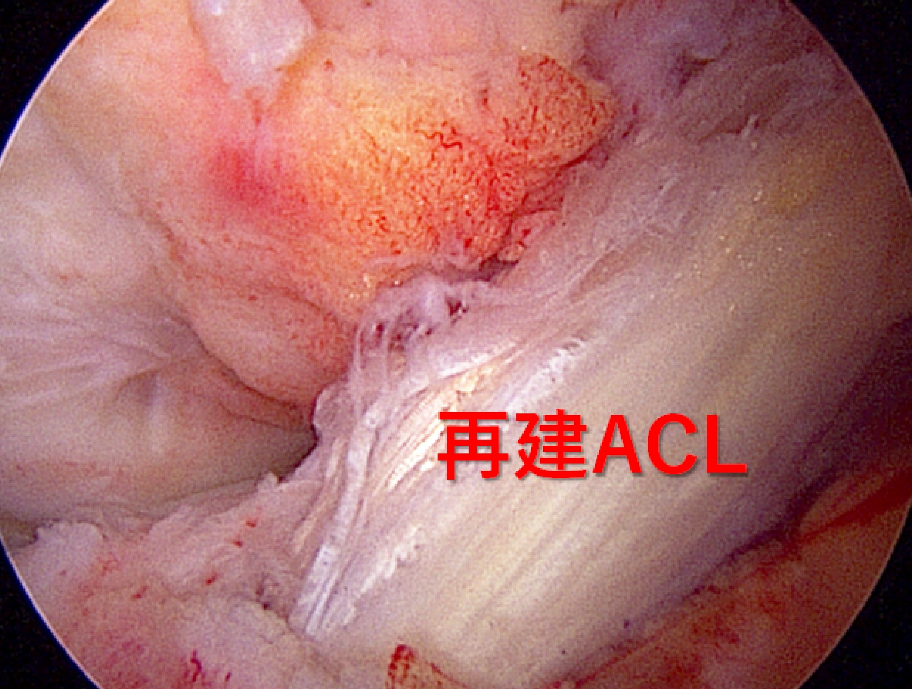 再建した前十字靭帯です。移植腱を正しい位置に固定して再建します。
