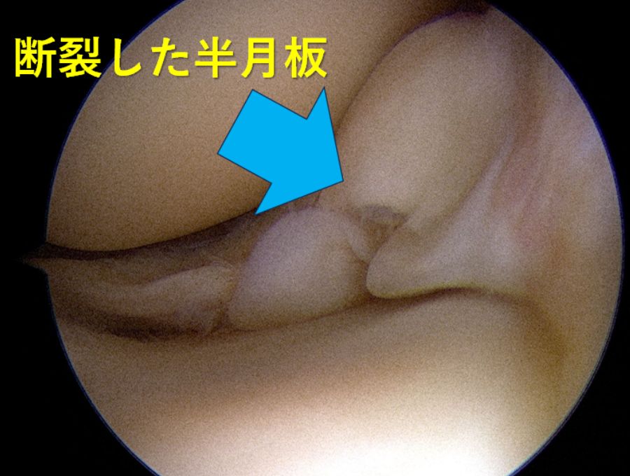 断裂した半月板です。断裂部がめくり返り痛みの原因となります。