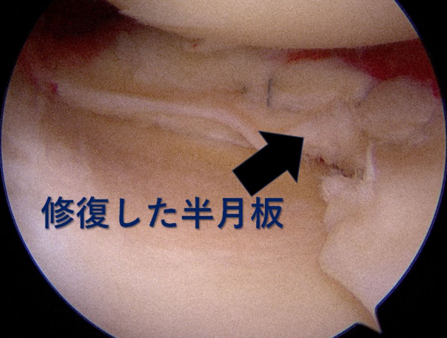 縫合した半月板です。縫合により安定しています。
              