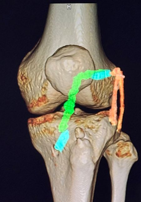 術後3D-CTの正面像です。新しいACL (緑色), 吸収性のスクリュー (水色), 新しいALL (オレンジ色)が確認できます。