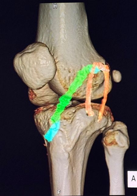 膝の前外側から見た3D-CTです。