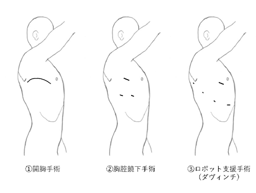 開胸、胸腔鏡、ロボット支援手術における創(ポート孔配置例)